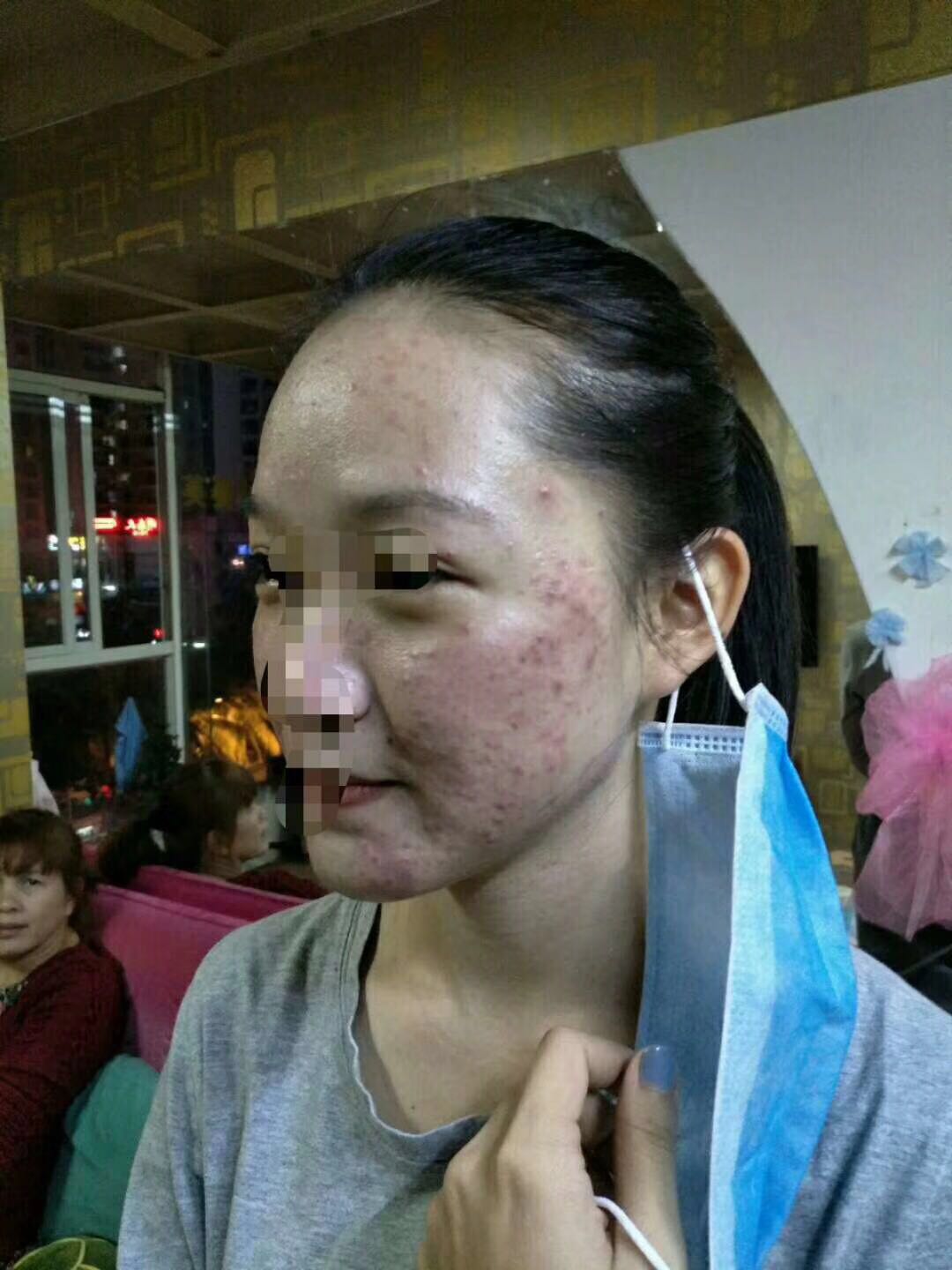 修复激素脸的美容院专家上海雅蓝娜化妆品代加