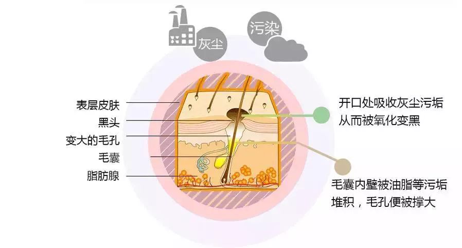 角栓暴露于外界,被空气氧化后,就形成了赶也赶不走的黑头