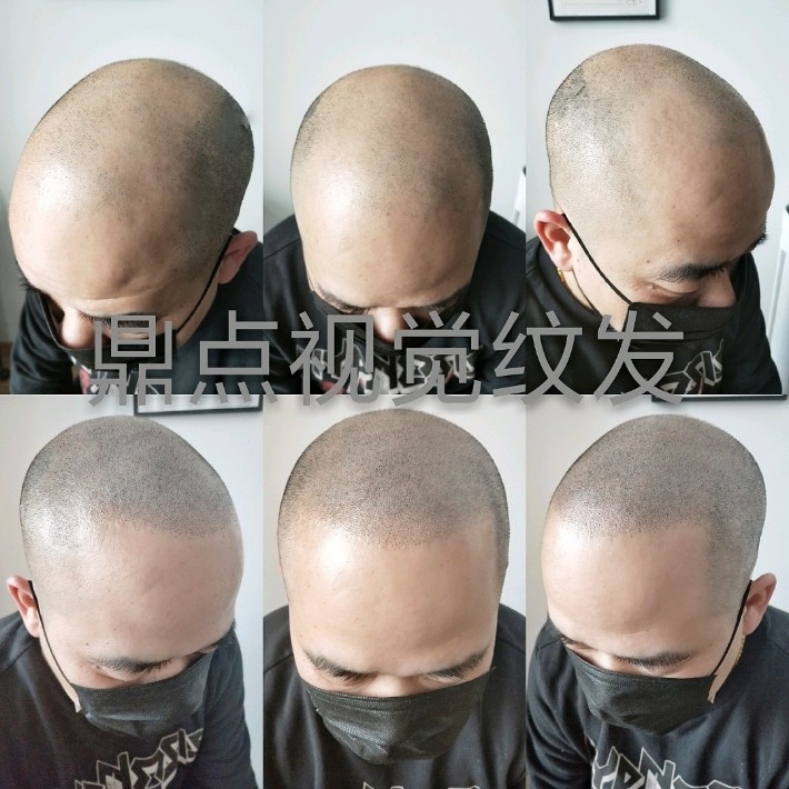 秃顶头发稀疏发际线后移可以用纹发来加以改善吗?