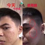 痘坑用什么修复效果好？七老总代理冯硕