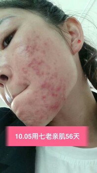 激素脸为什么会起疹子？怎么修复激素脸？七老总代冯硕