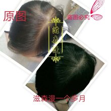 滋森漫止脱生发管用吗、滋森漫加盟代理、深圳脱发调理图片