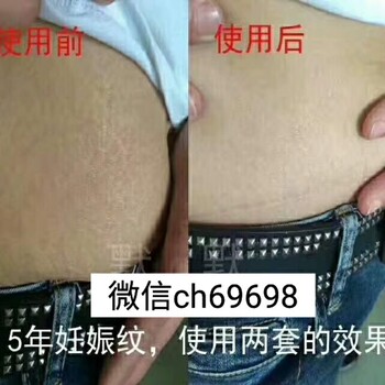 默默无纹辣妈套盒真能去妊娠纹吗