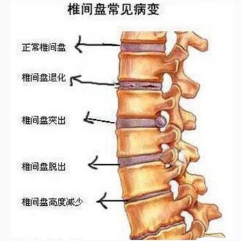 【北京腰间盘突出价格_乔氏黑玉膏分享腰突哪