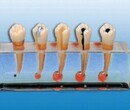 牙髓病临床模型