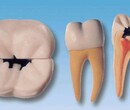 右侧第一颗磨牙蛀牙模型图片