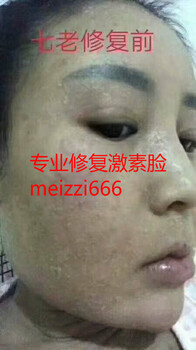 七老亲肌嫩肤乳可以修复激素脸吗？激素脸是什么？反复过敏是怎么回事？