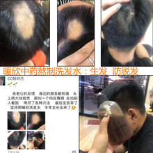 暖欣中药洗发水能生发效果好解决斑秃掉发脱发困扰图片
