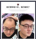 方城縣補發(fā)·高檔隱形假發(fā)-脫發(fā)白發(fā)專業(yè)修復中心