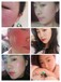 护肤导师刘素玲分享：激素脸后引起的黑色素沉积要怎么修护？