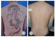 惠州洗纹身之激光洗纹身护理不当容易留疤
