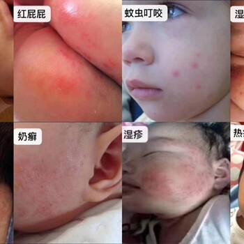 寶寶濕疹做好這幾點(diǎn)濕疹不在找你麻哈嬰樂(lè)霜